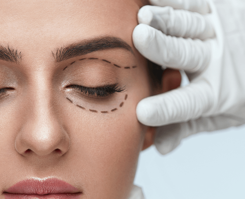 Blefaroplastia